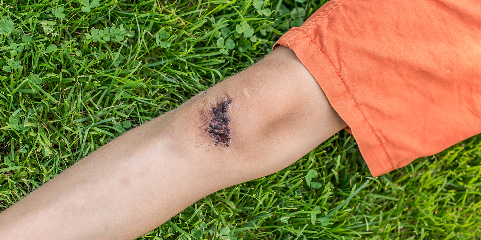 Schnell ist es passiert, das sich Kinder das Knie aufschürfen. Wie die Wunde heilt, haben ETH-Forschende nun genauer unter die Lupe genommen. (Bild: Colourbox)