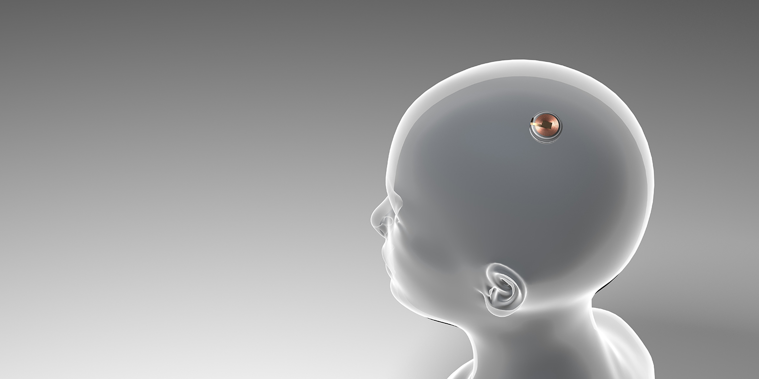 Implantat, welches eine Verbindung zwischen menschlichen Gehirn und Computern herstellt.