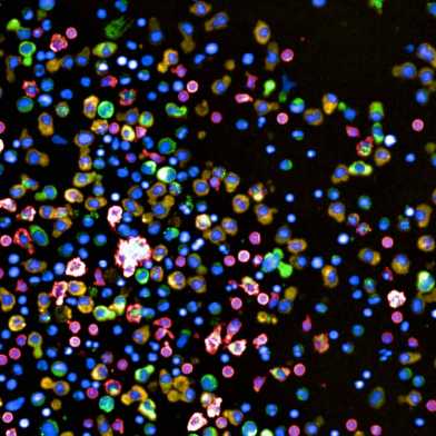 Nahaufnahmen von Zellen aus einer Knochenmarksbiopsie