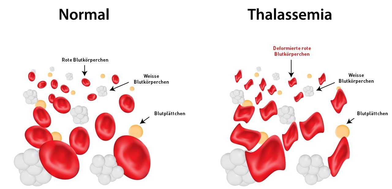 Vergr?sserte Ansicht: Der Unterschied zwischen den korrekt funktionierenden roten Blutkörperchen und denen mit einer Fehlfunktion.
