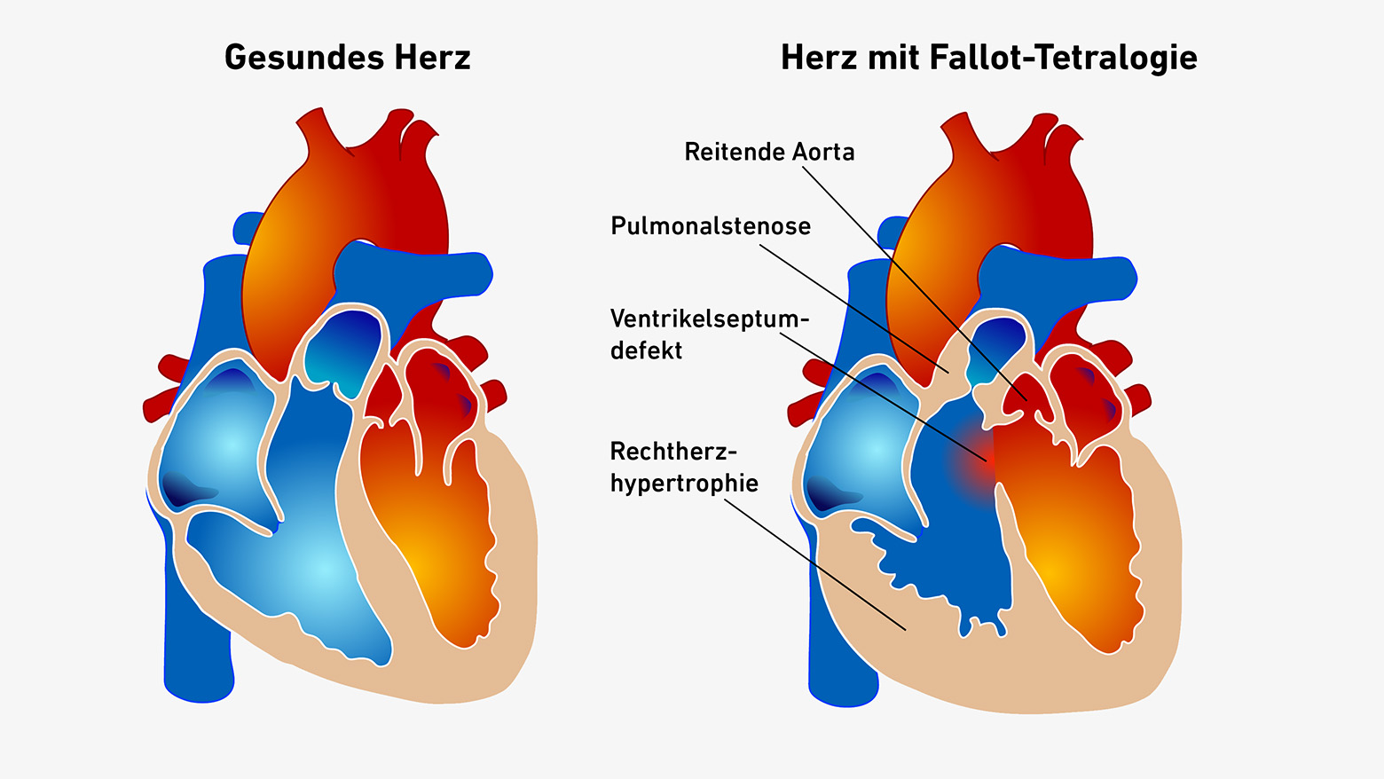 Vergr?sserte Ansicht: Schematische Darstellung eines gesunden Herzens neben einem Herzen mit Fallot-Tetralogie, bei welchem die Trennwand zwischen den beiden Herzkammern ein Loch aufweist.