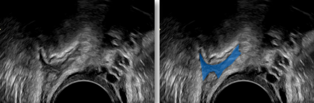 Zwei Ultraschallbilder, auf dem einen ist eine Stelle blau eingefärbt